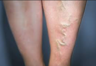 Varicose Veins